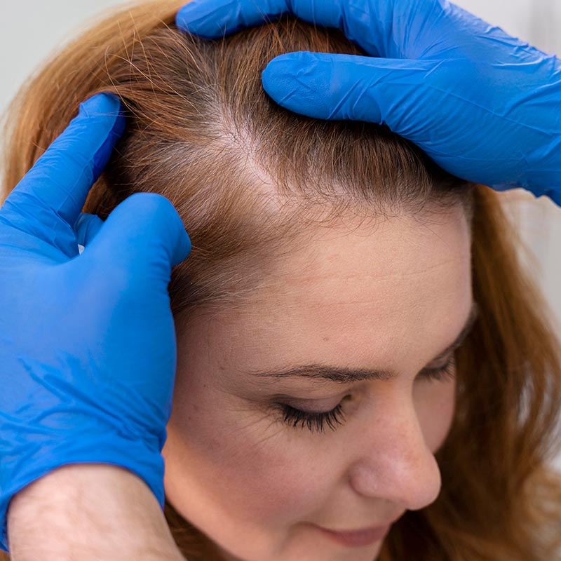 Alopecia - Androgenetica ou Calvície Feminina - Tratamentos e Transplante Capilar no Leblon - Rio de Janeiro - RJ