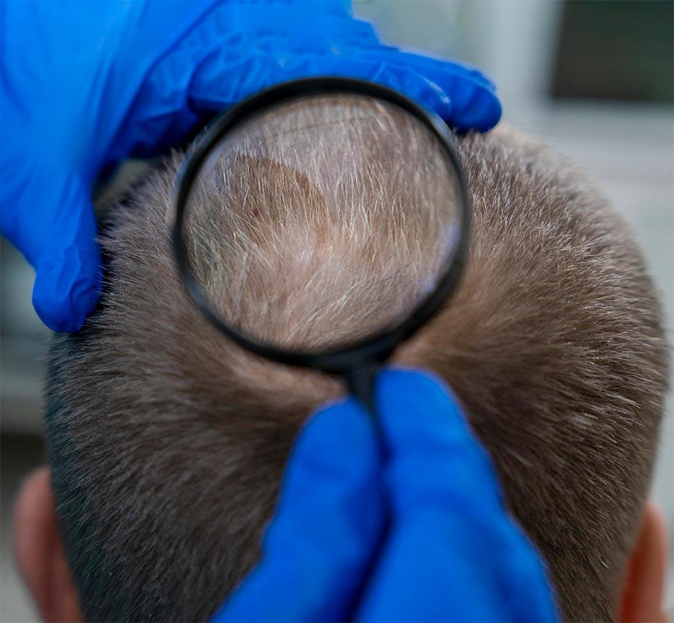 Body Hair Transplante Capilar no Leblon - Rio de Janeiro - RJ