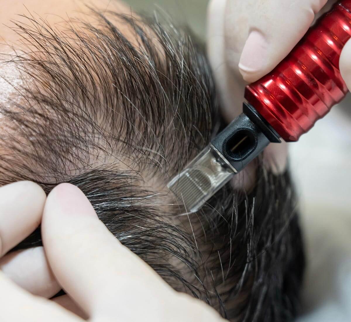 MMP, Microinfusão de Medicamentos pela Pele no Leblon - Rio de Janeiro - RJ